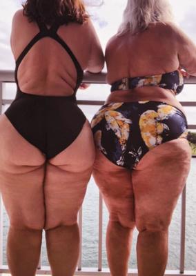 Cellulite Gets Even More Beautiful and Luxurious With Age