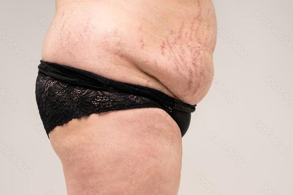 El cuerpo con estrías la pone más cachonda